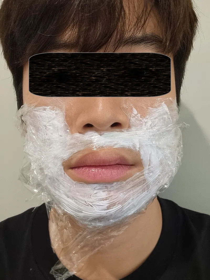 마취크림을 바르고 랩을 붙인 얼굴 제모 시술 전 모습