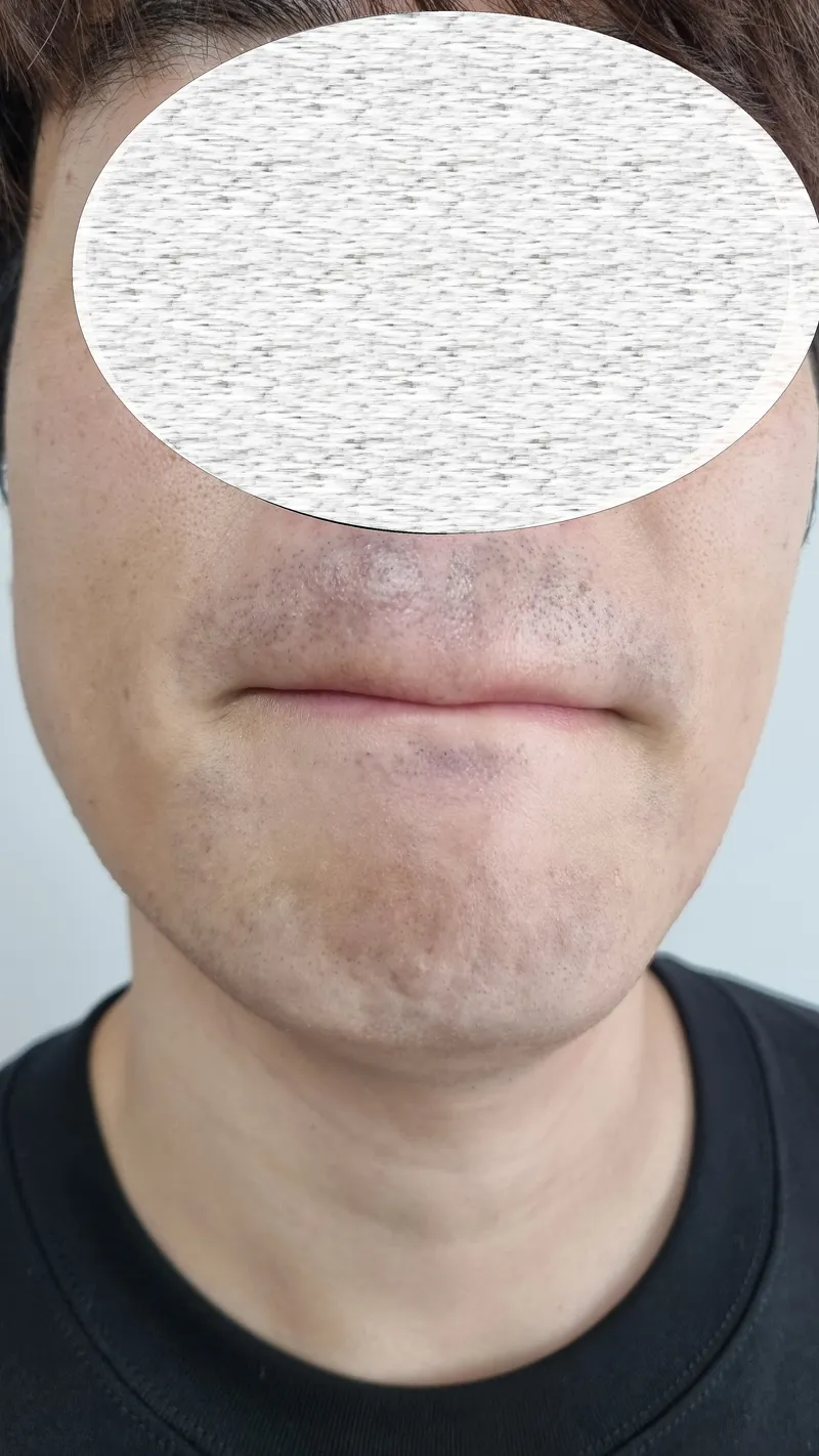 제모 시술 직후 인중과 턱 주변의 붉은기와 수염 상태