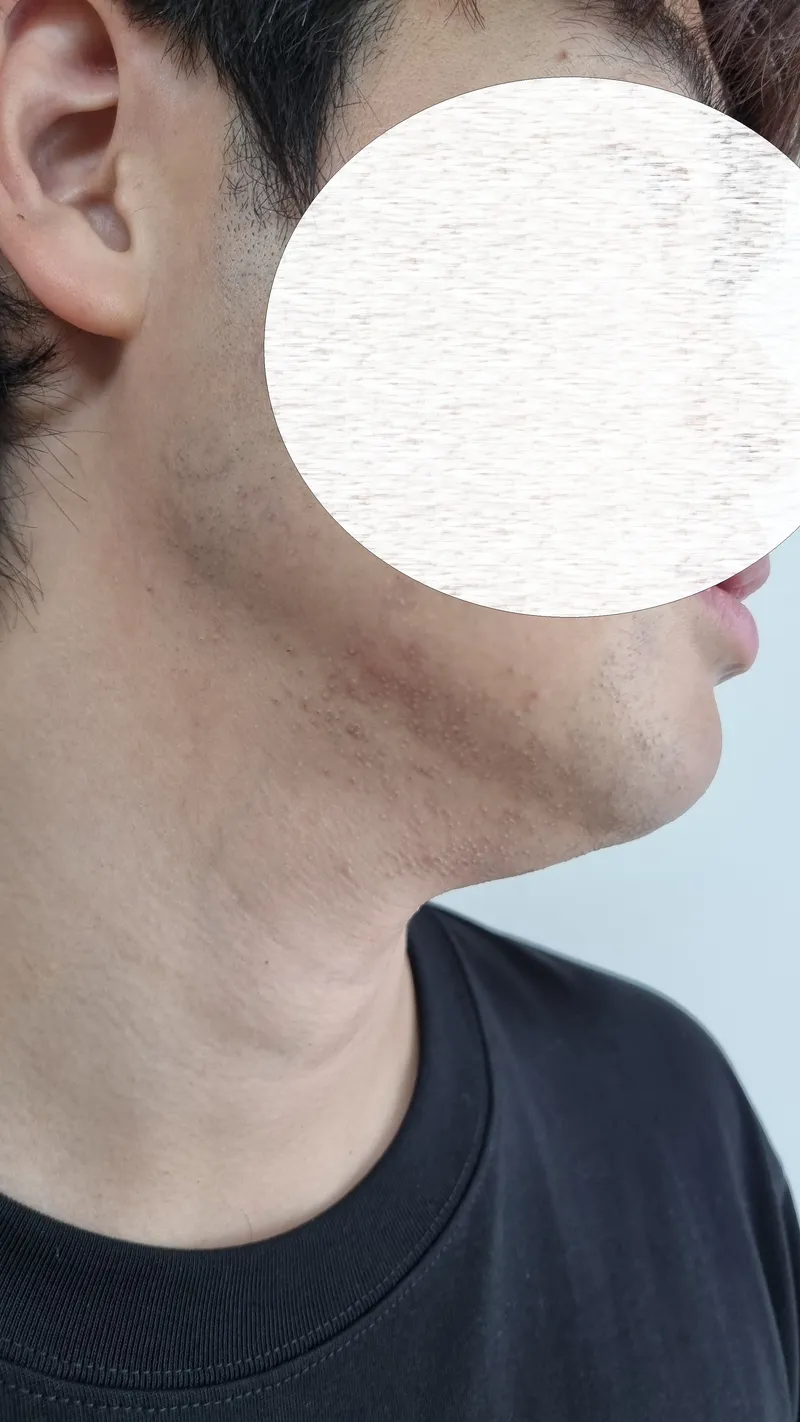 반대쪽 턱 라인과 피부 진정 상태를 담은 측면 모습