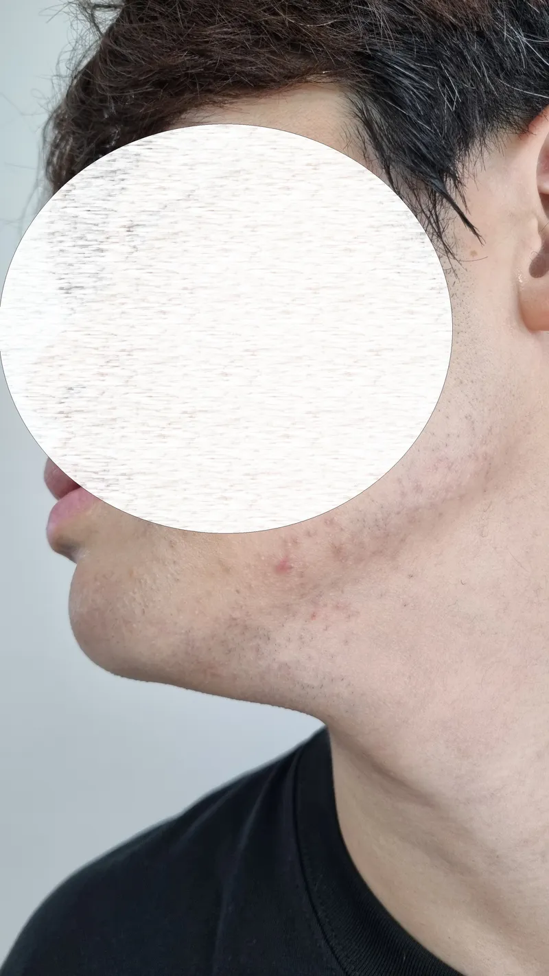 제모 후 턱선 라인과 트러블 예방 부위를 촬영한 측면 사진