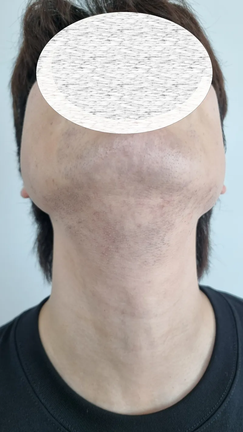 턱 아래쪽 수염과 모낭 상태를 보여주는 측면 모습